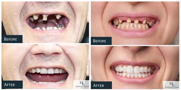 The before and after smile of two patients who underwent dental implant treatment