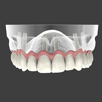 A denture and implants
