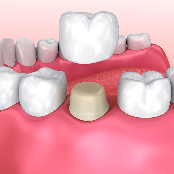 A 3D image of dental crowns