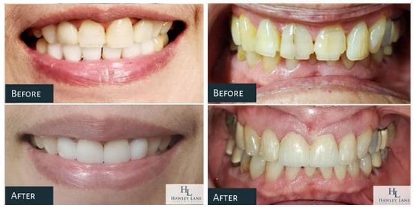 The before and after of a patient who underwent dental crown treatment