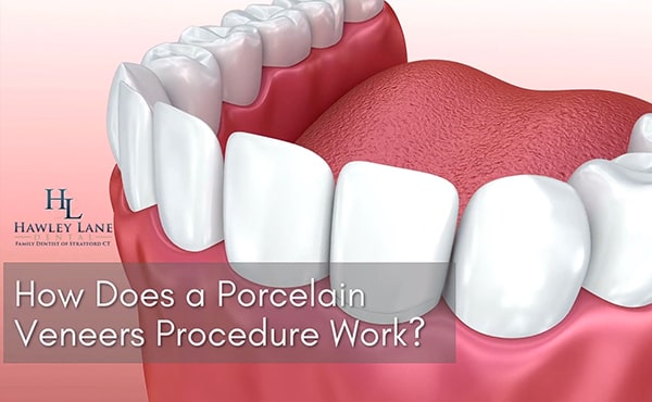 Veneers video thumbnail of a 3D illustration showing the procedure