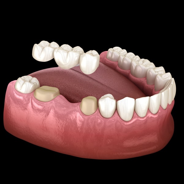 A 3D illustration showing the process of placing dental bridges